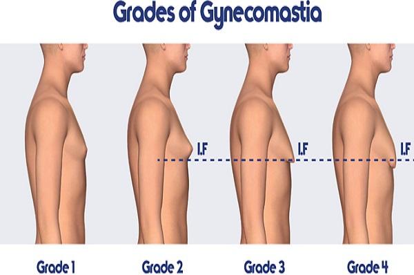 ГИНЕКОМАСТИЯ – причини, профилактика и лечение